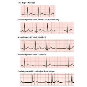 First Degree AV Block (Dark Soul Version)