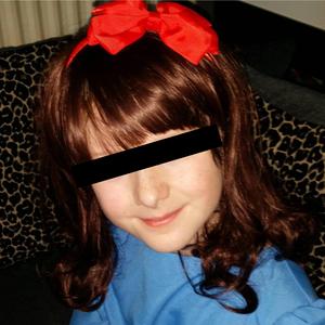 Alopecia