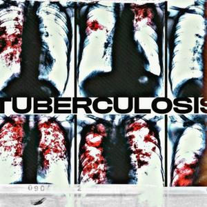 TUBERCULOSIS