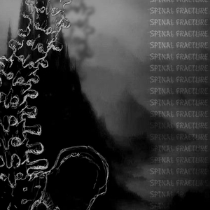 spinal Fracture