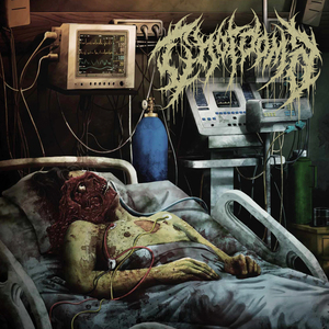 Suspensory Ligament Ejection