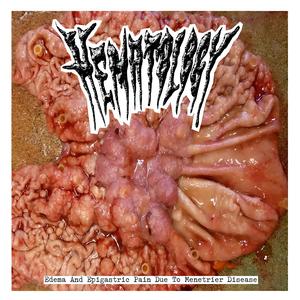 Leptospirosis Hematuria