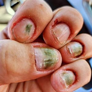 DERMATOPHAGIA