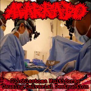 Glioblastoma Multiforme Causing Calvarial Destruction