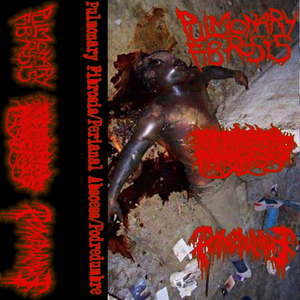 DIACETYL INDUCED BRONCHIOLITIS OBLITERANS