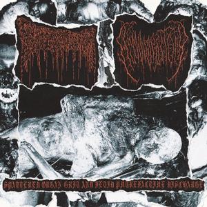 Suppurative Osteomyelitis