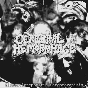 (Cerebral Hemorrhage) Glomerulonephritis Sarcomavanisis [Continuous Play]