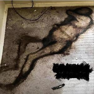 paralytic chondrotomy (feat. esophagus & abcess pool)