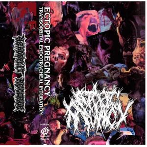 Orbital Myeloid Sarcoma