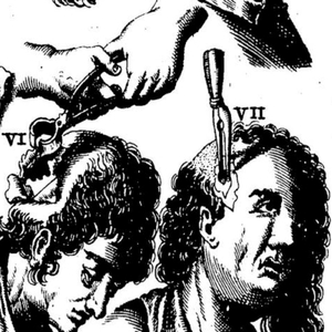Trepanation