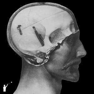 Microphthalmia