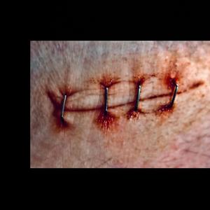 sutures