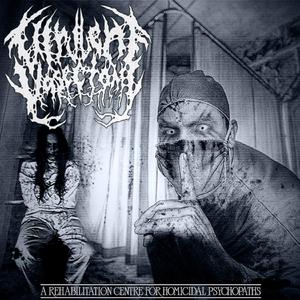 Phocomelia By A Thalidomide Effect