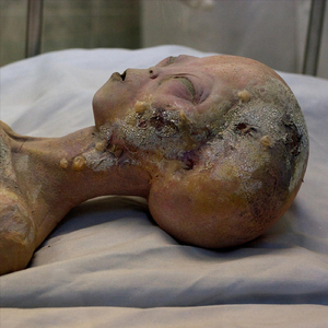 Autopsy