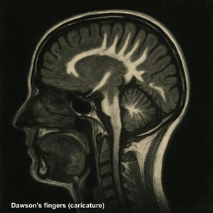 Multiple Sclerosis (Secondary Progressive Version)