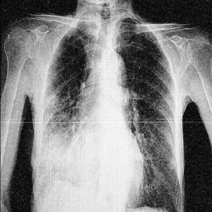 LUNGS (feat. DEFFISDEAD)