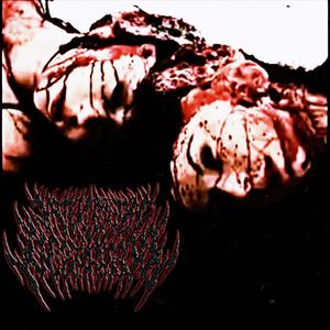 Hacksaw Craniectomy