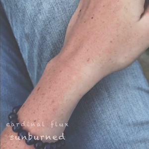 Sunburned