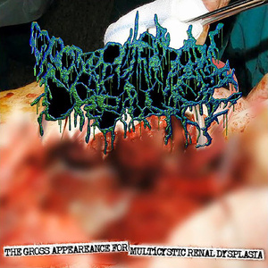 Endometrial Adenocarcinoma