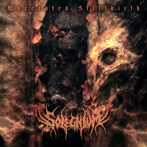 Macerated Stillbirth
