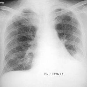 PNEUMONIA