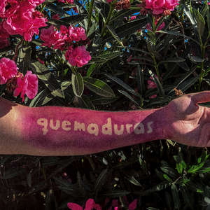 quemaduras