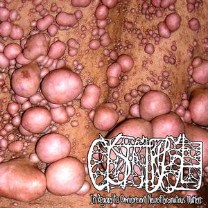 Esoteric Mindsets towards Malignant Oligodendroma