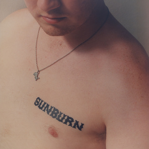 Sunburn
