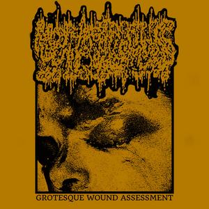 Endoscopic Retrograde Cholangiopancreatographic Disembowelment