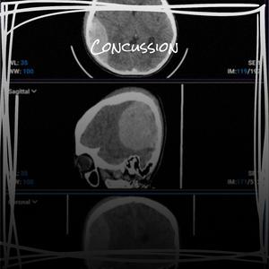 Concussion