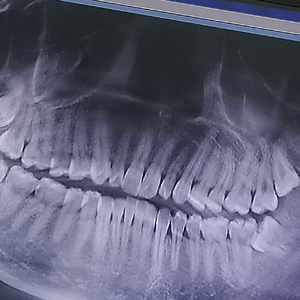 中国人的阻生智齿