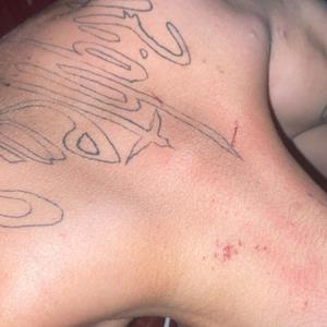 battle scars
