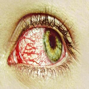 Pinkeye