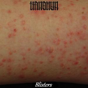 Blisters
