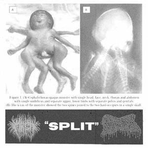 4-Tracks Cephalothoracopagus Monster Split w/Craniofacial Degloving