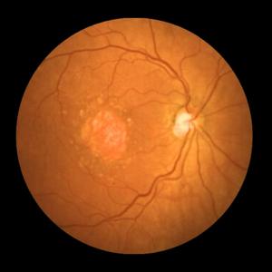 Avacincaptad Pegol (Big Dumb Rock Version)