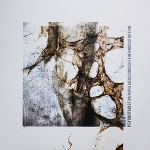 Neuropatia Sensitiva Subacuta