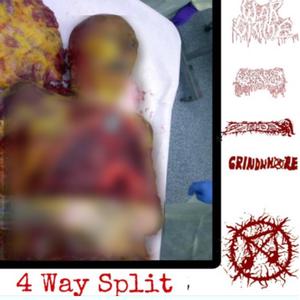 Swollen Septic Cyst (grindwhore)