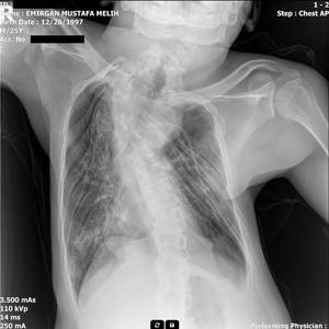 Pelvis ap