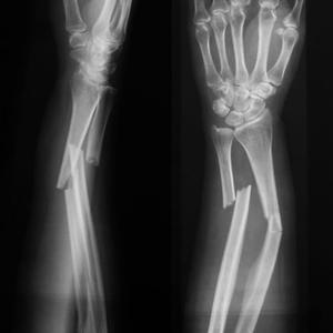 fracture