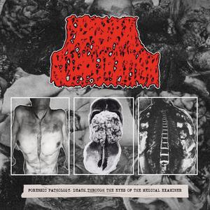 Embryonal Rhabdomyosarcoma (Sarcoma Botryoides)