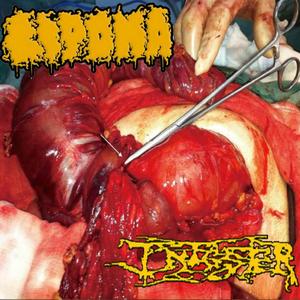 A rare hematoma (a report of two cases)