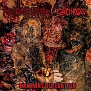 Epidermodisplasia Verruciformis