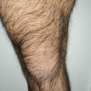 Patella