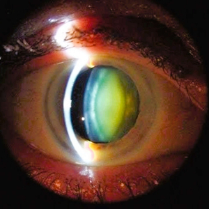CATARACT
