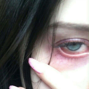 Suicide