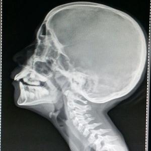 Neck Fracture