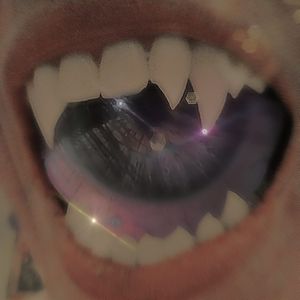 Aniridia