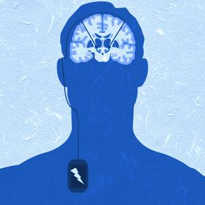 DBS for Parkinson's Disease (Understated Version)