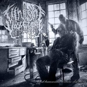 Phocomelia By A Thalidomide Effect